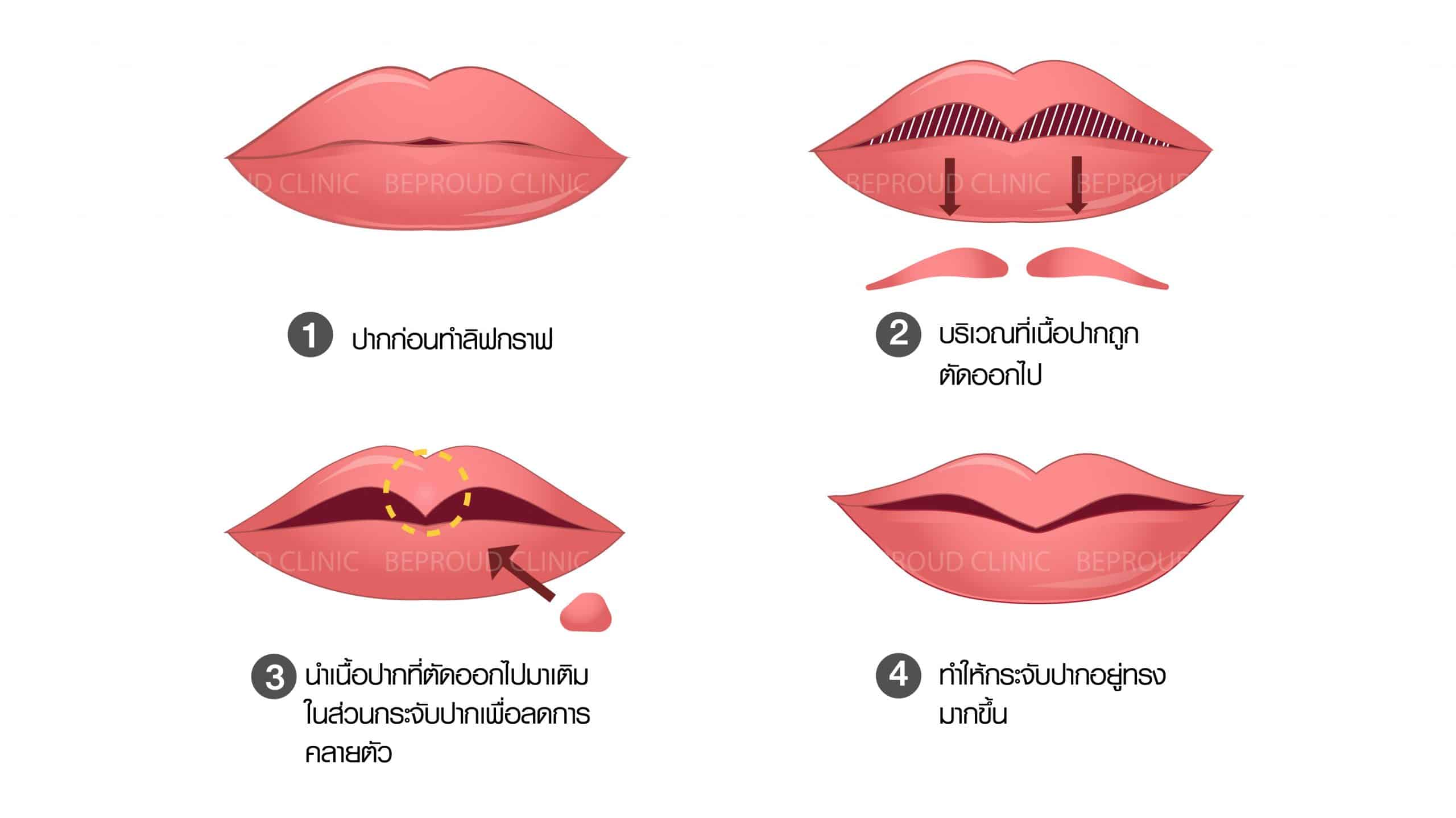 ขั้นตอนการผ่า ขั้นตอนการผ่า