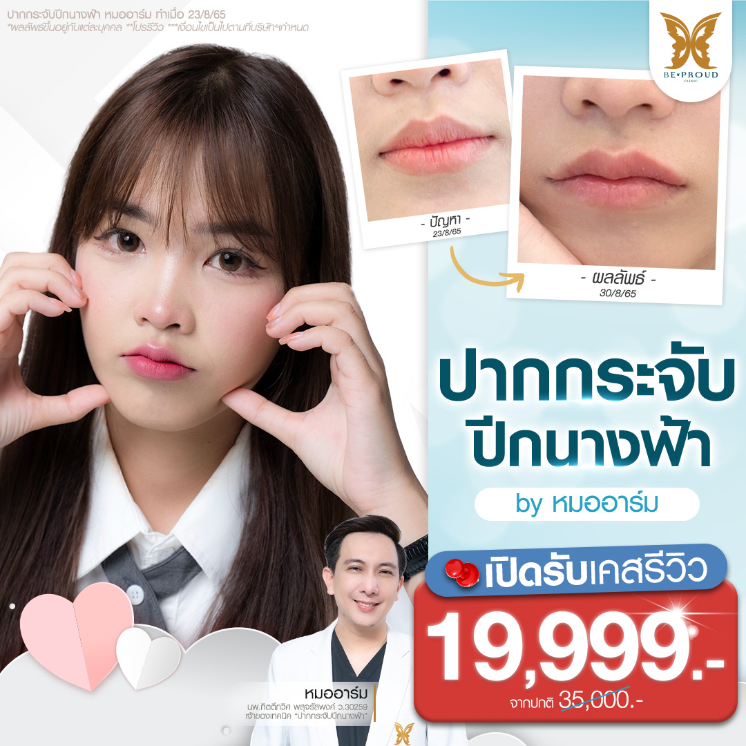 ภาพโปรโมชั่นศัลยกรรมปากกระจับปีกนางฟ้าราคาพิเศษสำหรับเคสรีวิว โดยหมออาร์ม ที่บีพราวด์คลินิก แสดงภาพตัวอย่างเคสลูกค้าทำปาก รีวิวเปรียบเทียบก่อน-หลังทำศัลยกรรมปาก