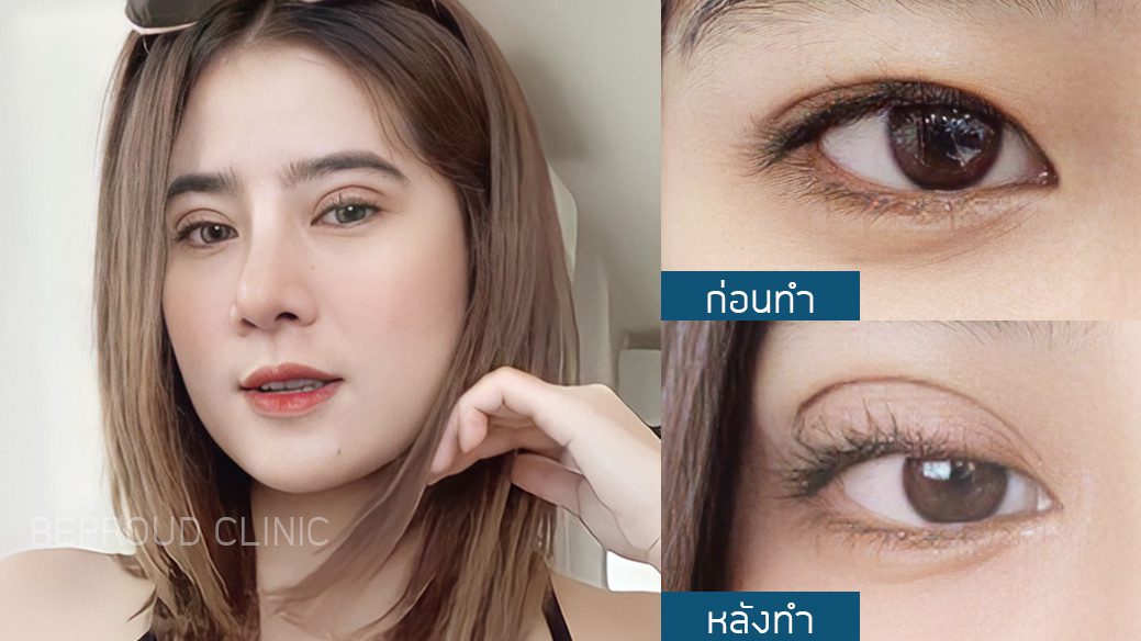 เทคนิค กรีดตายาว หนังตาตก ตาสองชั้น