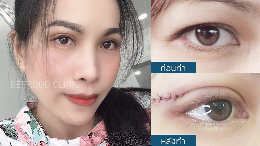 เทคนิค ยกหางหงส์ เทคนิค ยกหางหงส์