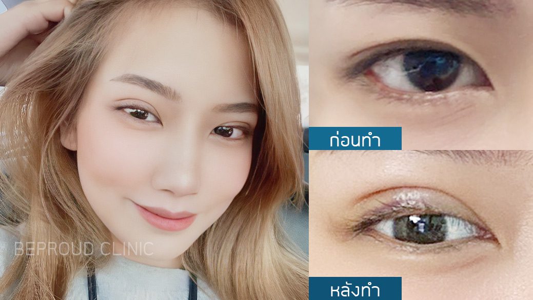 เทคนิค กรีดตายาวแผลมินิ เทคนิค กรีดตายาวแผลมินิ