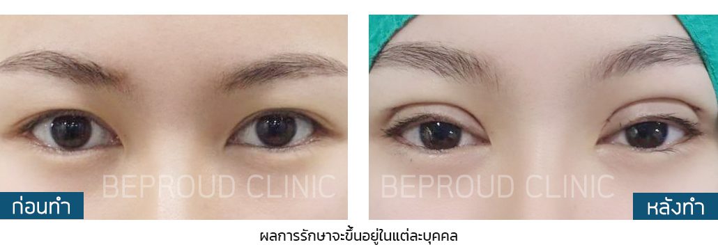 กรีดตายาว ผลลัพธ์ กรีดตายาว ผลลัพธ์ หนังตาตก ตาสองชั้น
