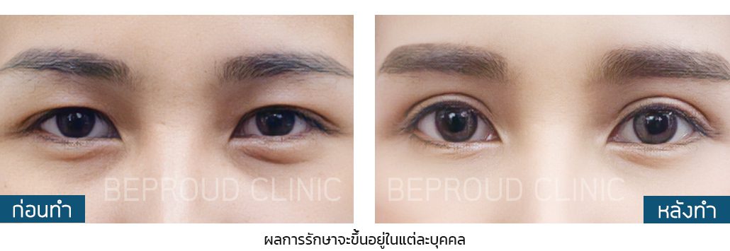 กรีดตายาว ผลลัพธ์ 2 กรีดตายาว ผลลัพธ์ 2