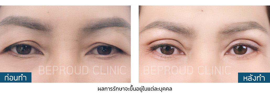 หางหงส์ ผลลัพธ์ หางหงส์ ผลลัพธ์