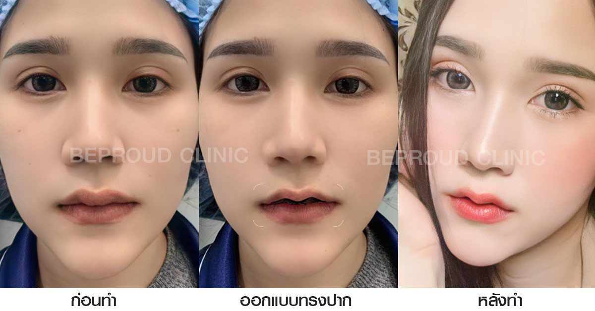 ออกแบบ ทรงปาก