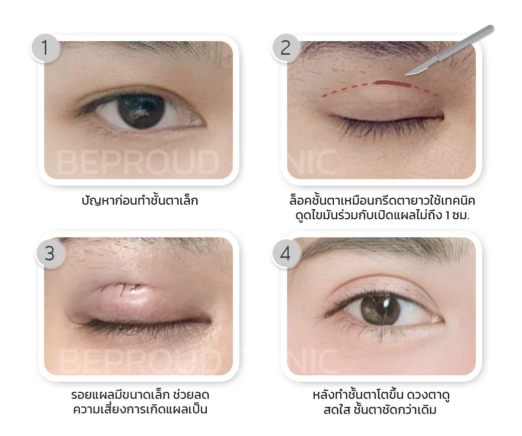 เทคนิค แผลมินิ เทคนิค แผลมินิ