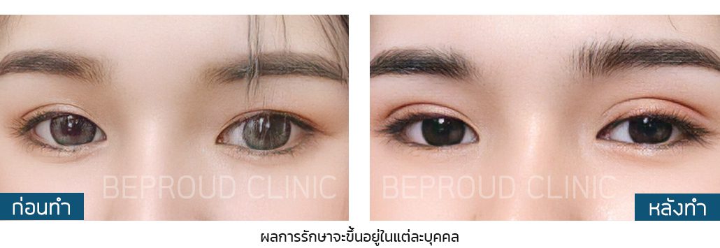 แผลมินิ ผลลัพธ์ แผลมินิ ผลลัพธ์