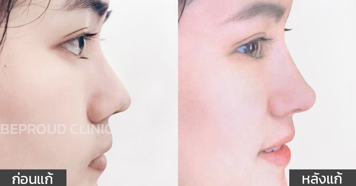 ปรับโครงสร้างจมูก ปรับโครงสร้างจมูก