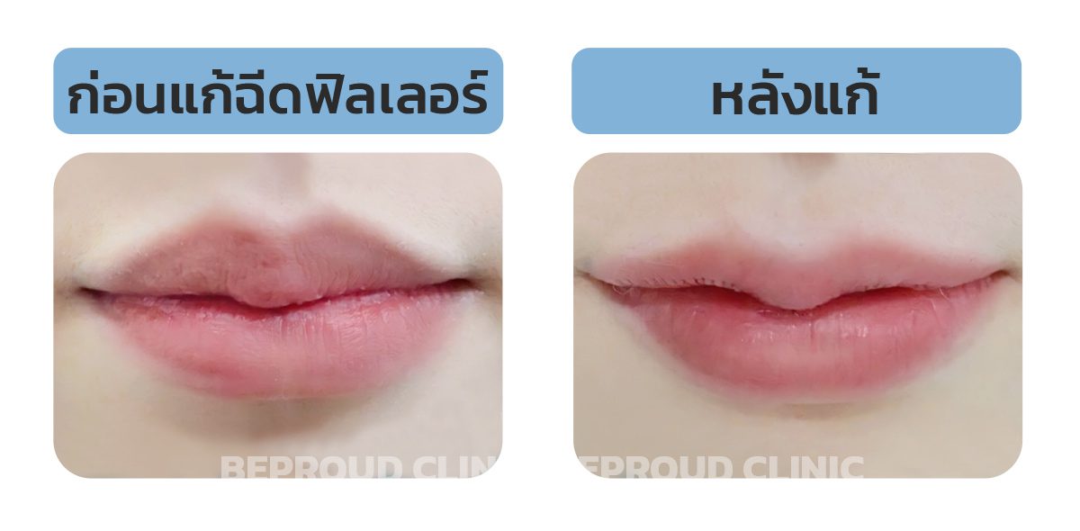 ฉีดฟิลเลอร์มาทำปากได้มั้ย ฉีดฟิลเลอร์มาทำปากได้มั้ย