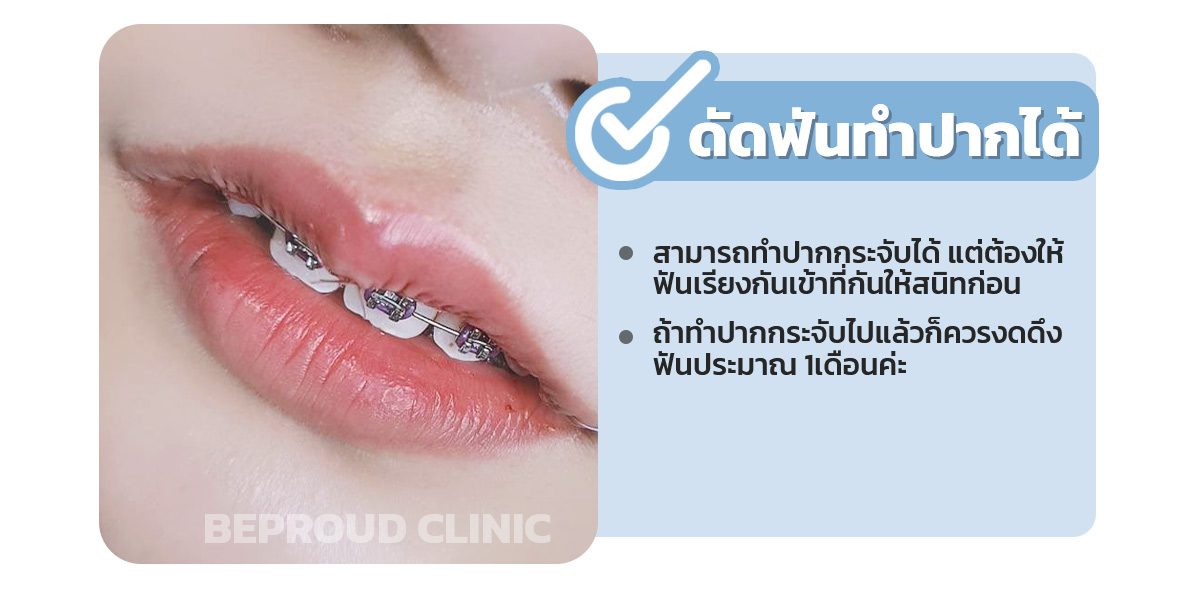 ดัดฟันทำปากกระจับได้มั้ย ดัดฟันทำปากกระจับได้มั้ย