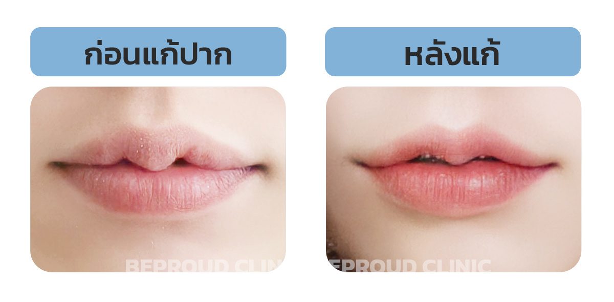 ทำปากมาแก้ปากได้มั้ย ทำปากมาแก้ปากได้มั้ย
