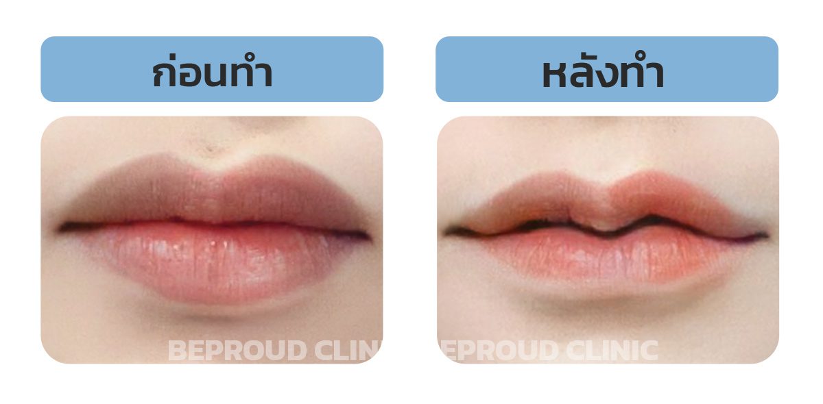 ปากคว่ำทำปากได้มั้ย ปากคว่ำทำปากได้มั้ย