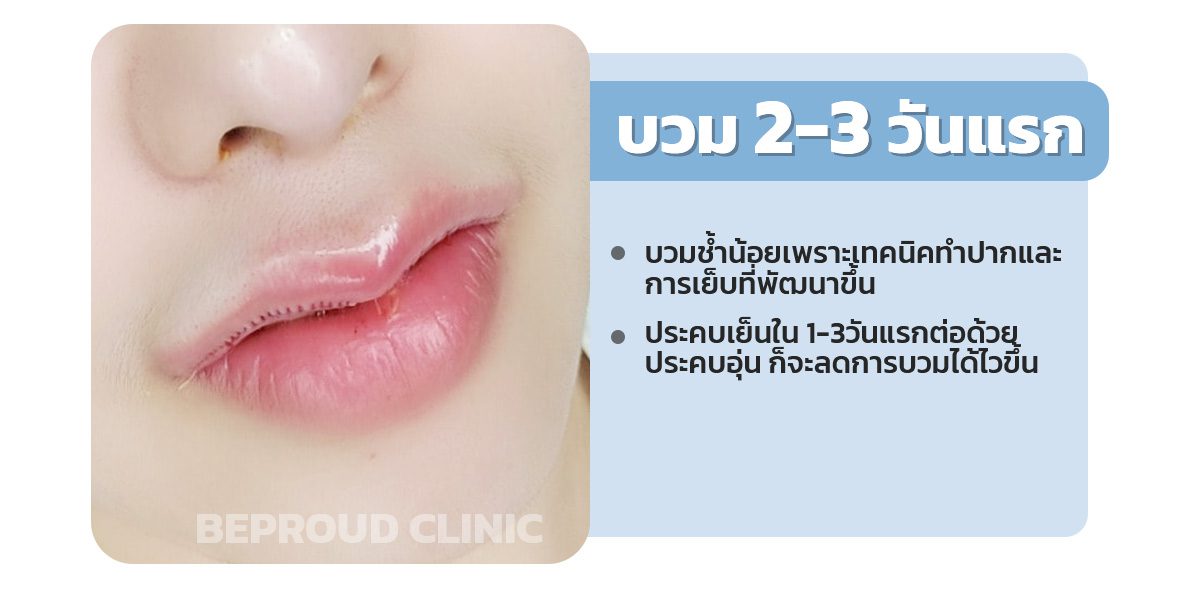 ปากบวมกี่วัน ปากบวมกี่วัน