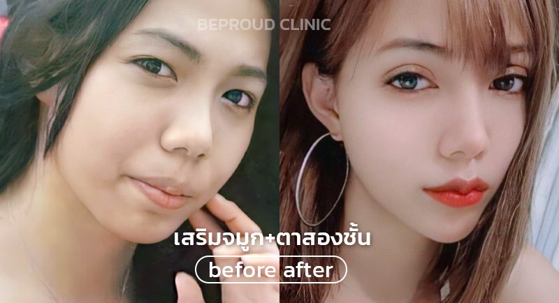 ทำจมูกตา ทำจมูกตา