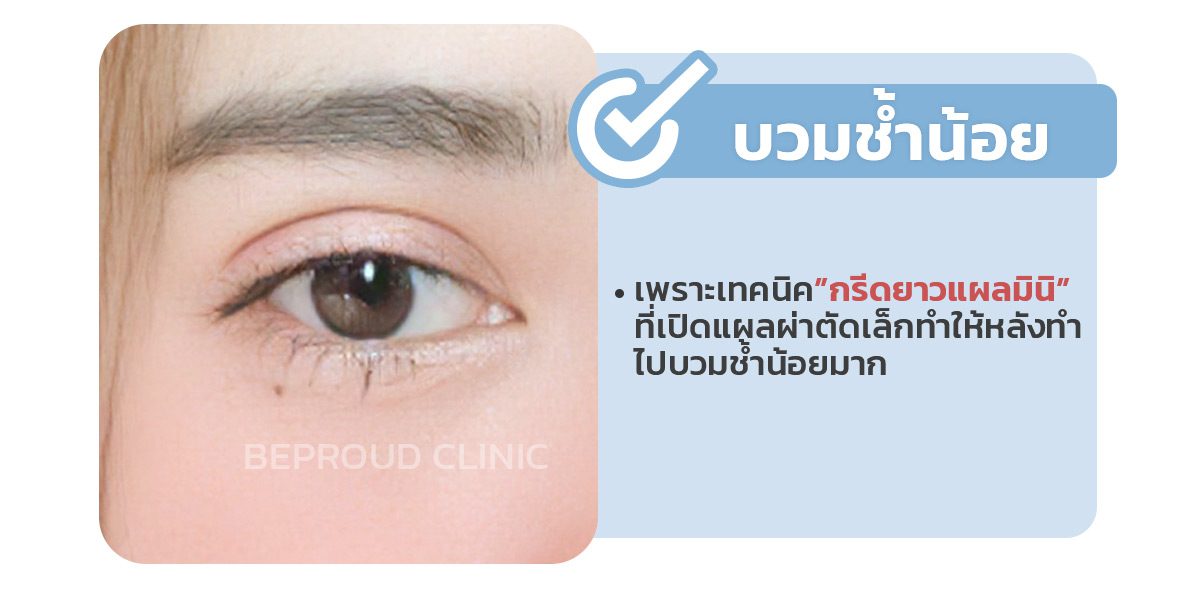 ทำตาบวมช้ำเยอะมั้ย