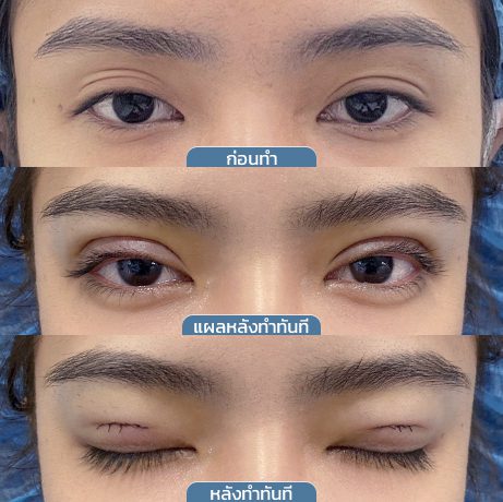 ก่อนหลัง_จุดเริ่มต้นกรีดแผลมินิ_3ช่อง2
