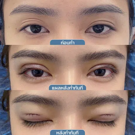 ก่อนหลัง_จุดเริ่มต้นกรีดแผลมินิ_3ช่อง2