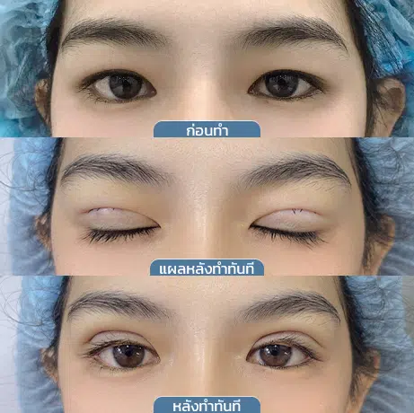 ก่อนหลัง_จุดเริ่มต้นกรีดแผลมินิ_3ช่อง3