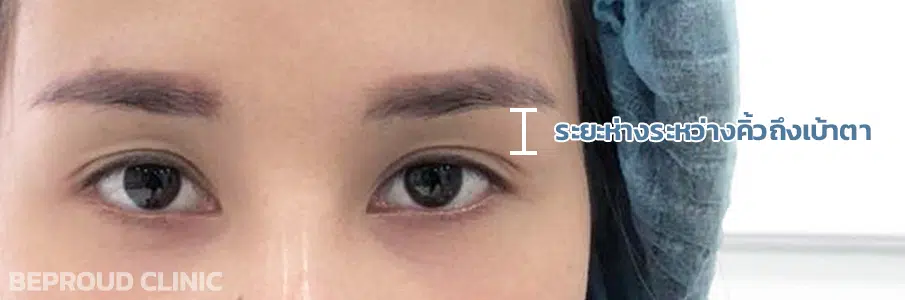 ระยะห่างของเบ้าตา