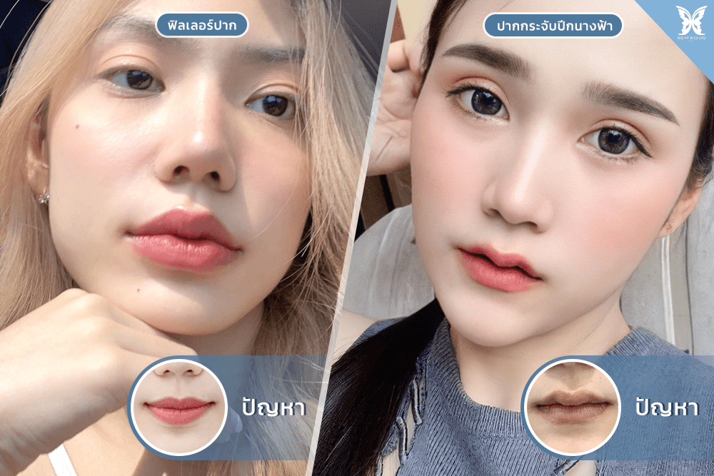 ฉีดฟิลเลอร์ปาก-ปากกระจับ-ฉีดฟิลเลอร์ปากสามารถทำปากกระจับได้ไหม ฟิลเลอร์-ปากกระจับ-ฉีดฟิลเลอร์ปากสามารถทำปากกระจับได้ไหม