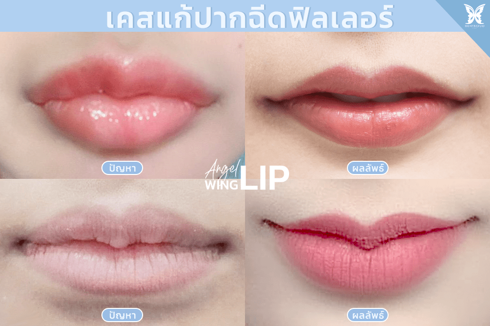 เคสแก้ปากฉีดฟิลเลอร์-ฉีดฟิลเลอร์ปากสามารถทำปากกระจับได้ไหม เคสแก้ปากฉีดฟิลเลอร์-ฉีดฟิลเลอร์ปากสามารถทำปากกระจับได้ไหม