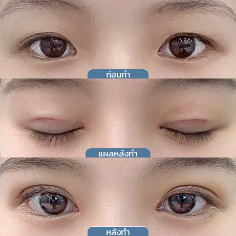 ก่อน_หลัง_แผลตาสองชั้น_3