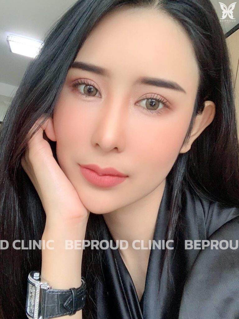 คนสวย-ฉีดฟิลเลอร์ปากสามารถทำปากกระจับได้ไหม-2 คนสวย-ฉีดฟิลเลอร์ปากสามารถทำปากกระจับได้ไหม-2