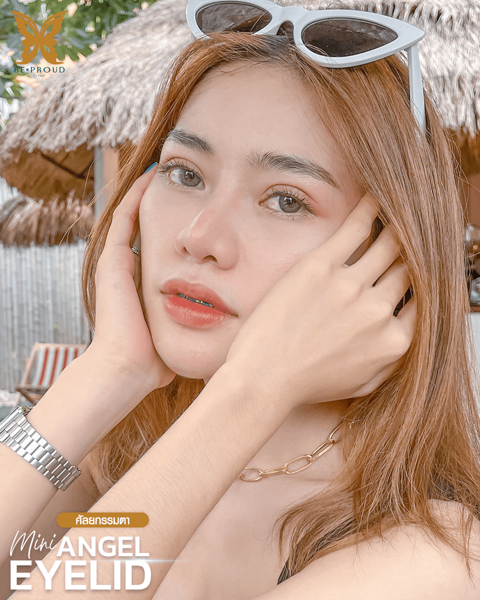 รีวิวตาสองชั้นกรีดยาวแผลมินิ-05 รีวิวตาสองชั้นกรีดยาวแผลมินิ-05