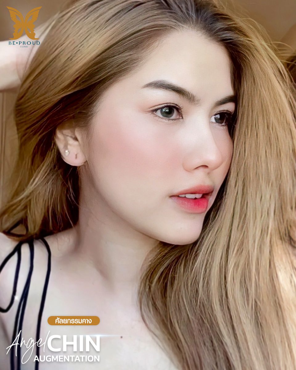 รีวิวเสริมคาง-10 รีวิวเสริมคาง-10
