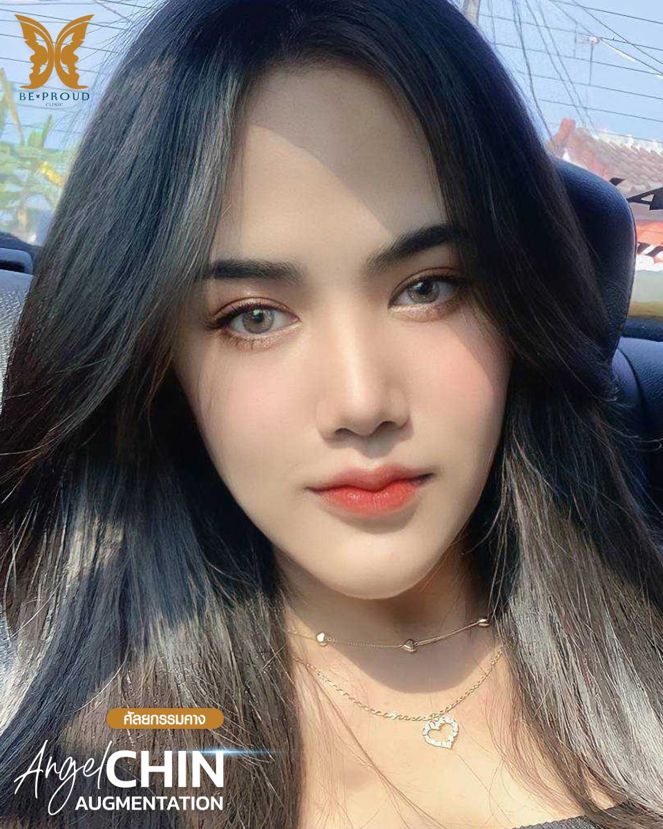 รีวิวเสริมคาง-11 รีวิวเสริมคาง-11