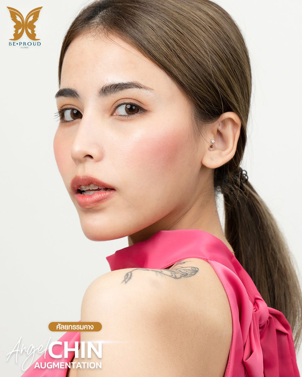 รีวิวเสริมคาง-09 รีวิวเสริมคาง-09