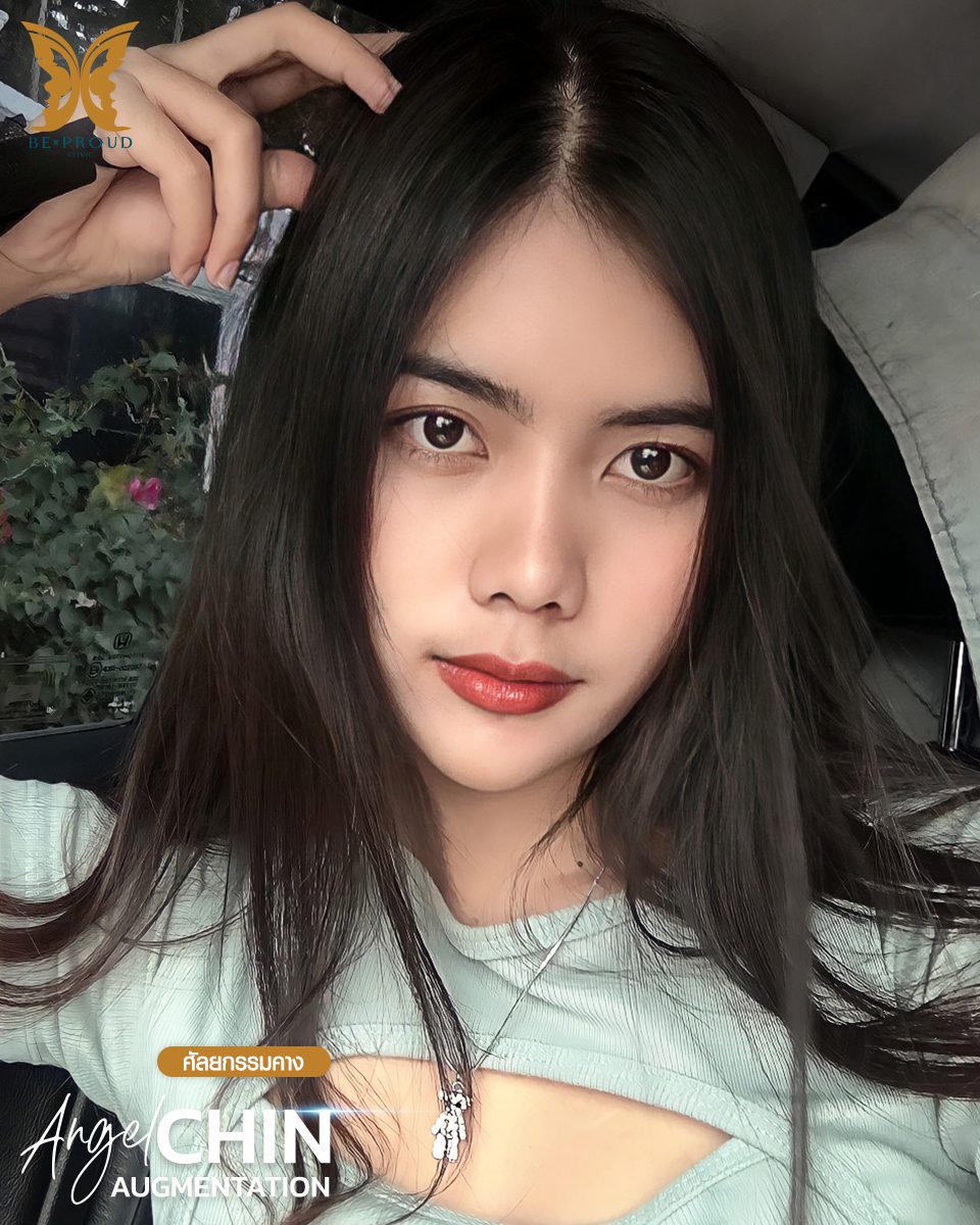 รีวิวเสริมคาง-07 รีวิวเสริมคาง-07