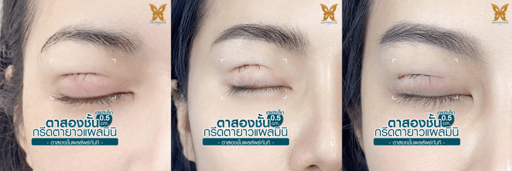 รวม ตาสองชั้นกรีดยาวแผลมินิ-02