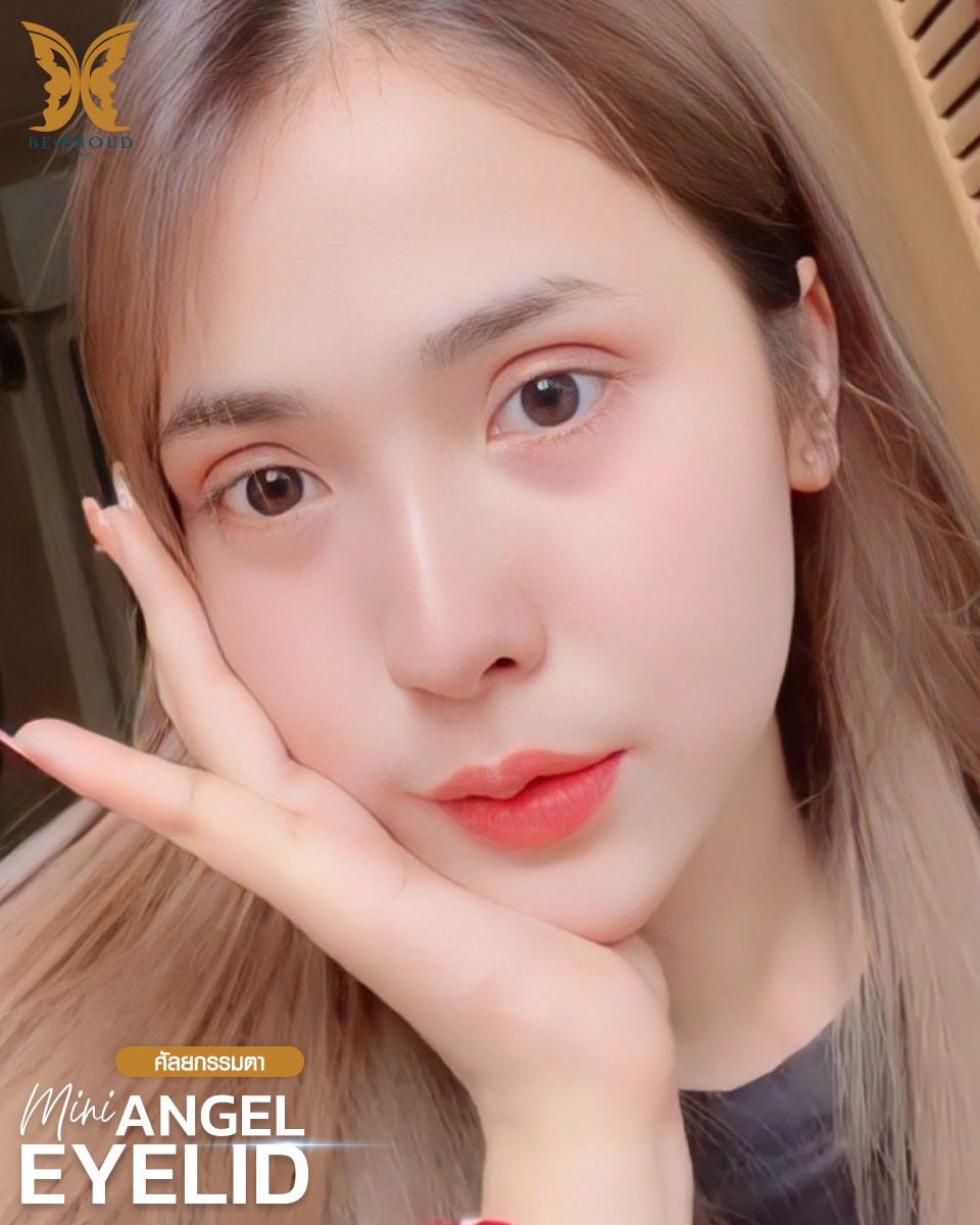รีวิวตาสองชั้นกรีดยาวแผลมินิ-04 รีวิวตาสองชั้นกรีดยาวแผลมินิ-04