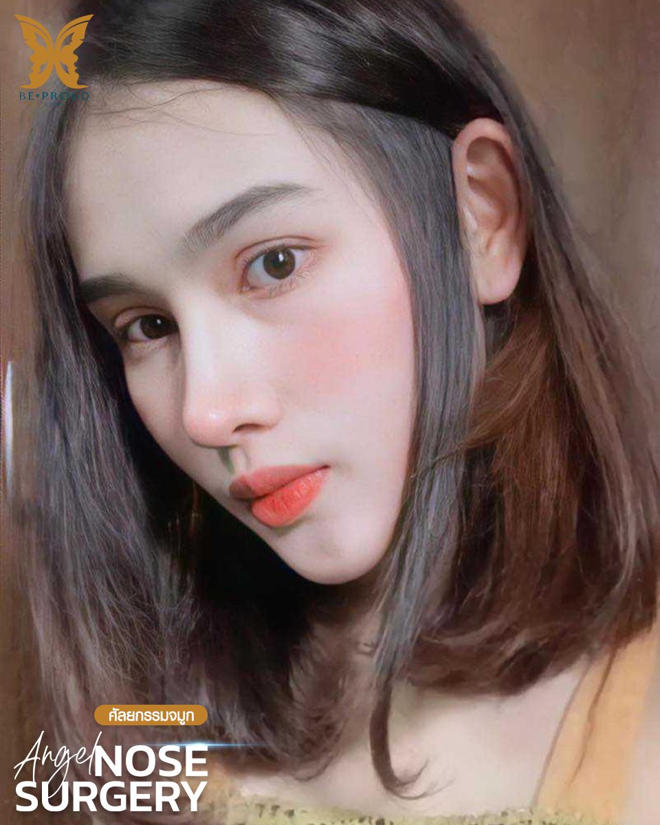 รีวิวเสริมจมูก(4)