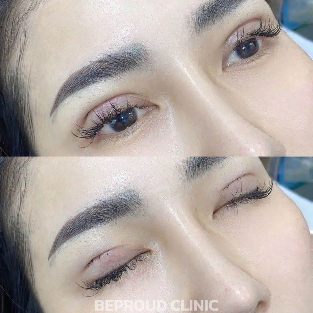 เทคนิคกรีดตายาวแผลมินิ