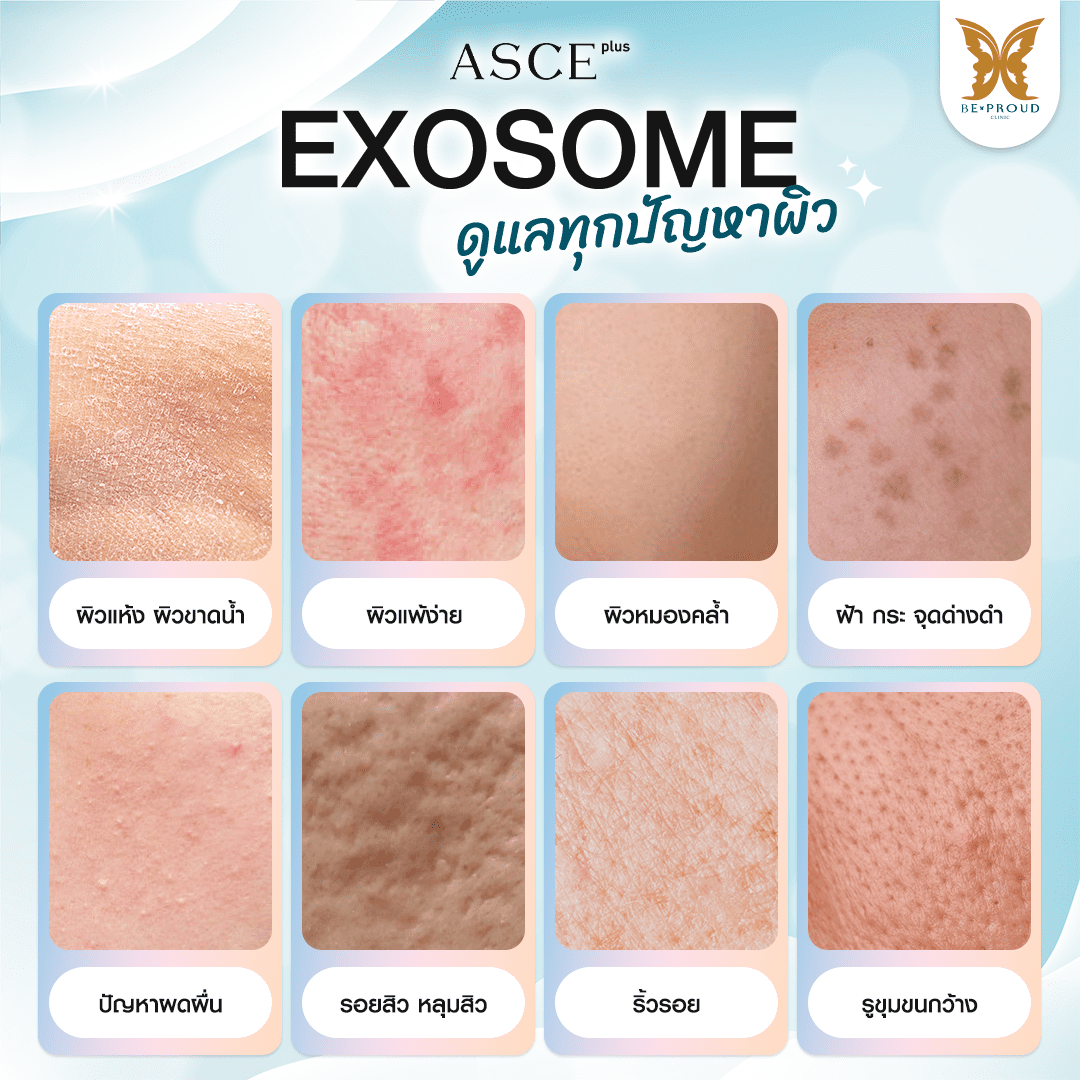 Exosome เหมาะกับใคร