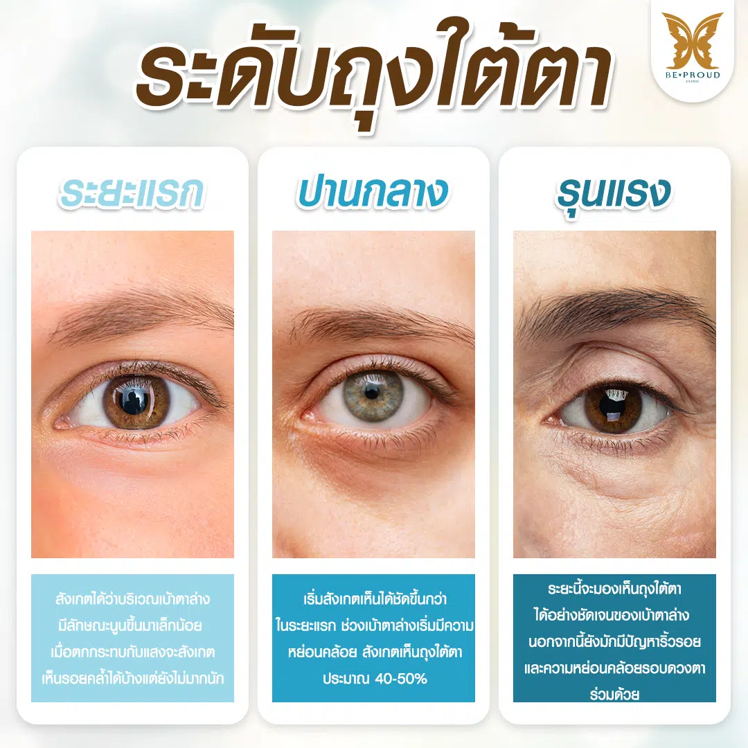 เช็ดระดับถุงใต้ตา ถุงใต้ตา