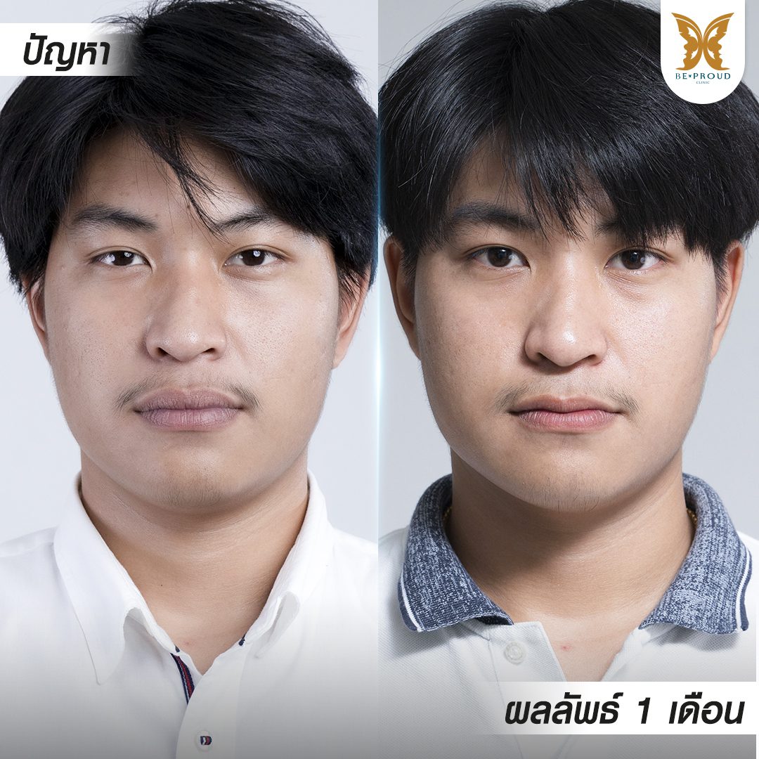 1080_1080-2-2 (2) ปากกระจับผู้ชาย