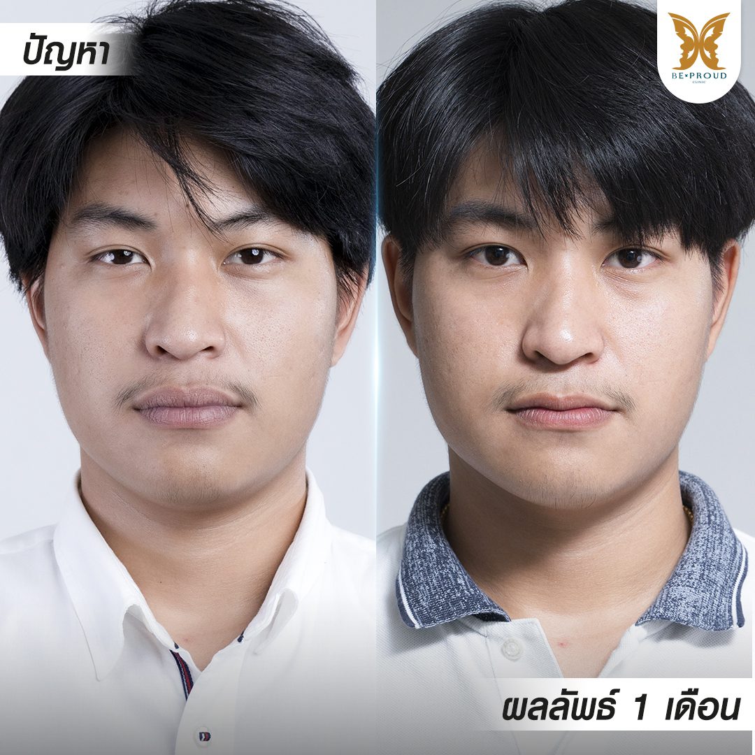 ปากกระจับผู้ชาย