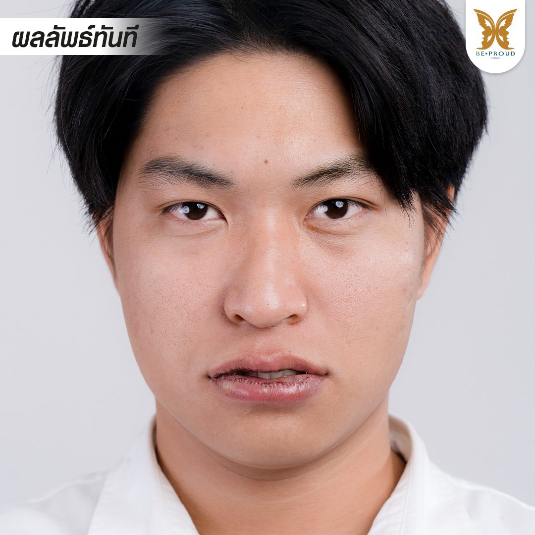 ผลลัพธ์ทันที 1 ปากกระจับผู้ชาย