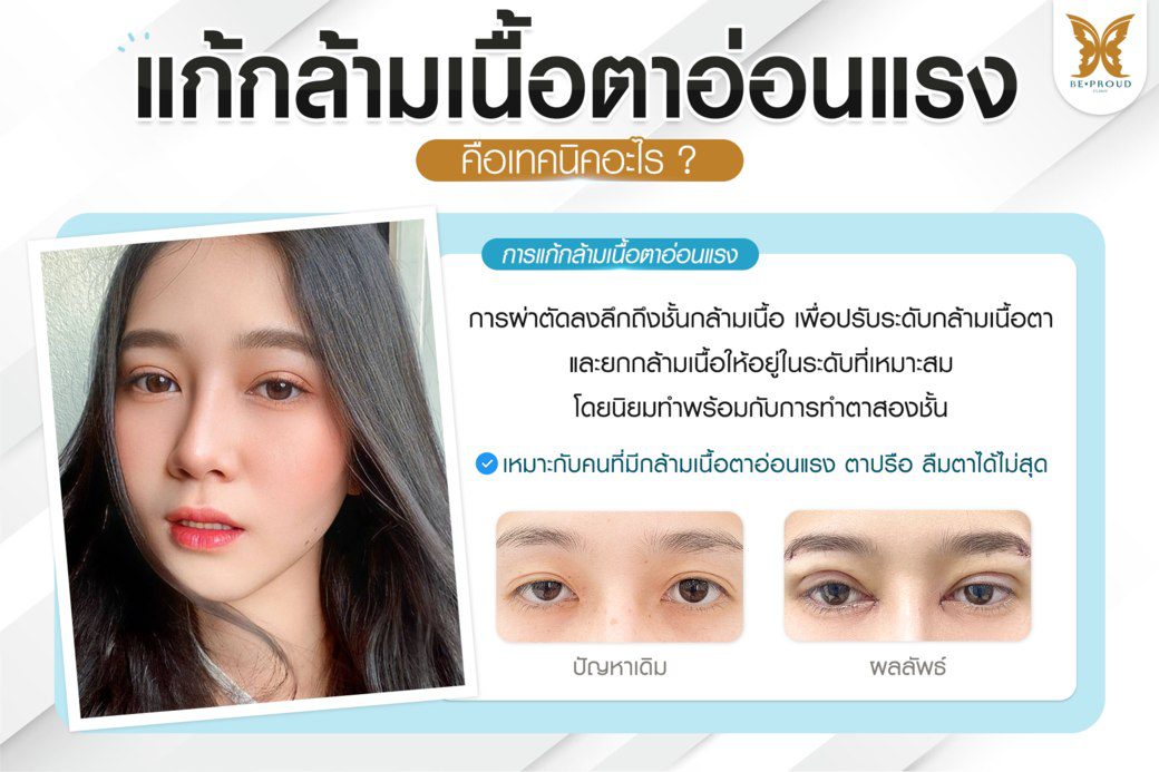 แก้กล้ามเนื่อตาอ่อนแรง แก้กล้ามเนื่อตาอ่อนแรง