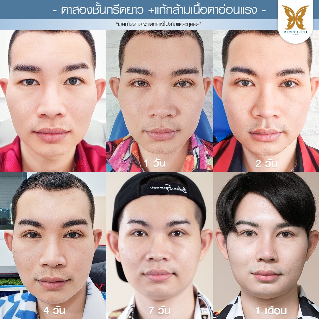 แก้กล้ามเนื้อตาอ่อนแรง แก้กล้ามเนื้อตาอ่อนแรง