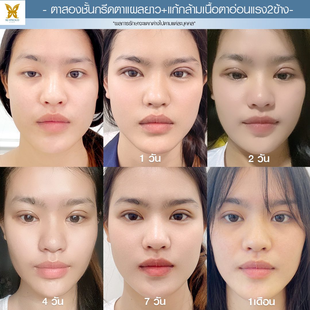 แก้กล้ามเนื้อตาอ่อนแรง แก้กล้ามเนื้อตาอ่อนแรง