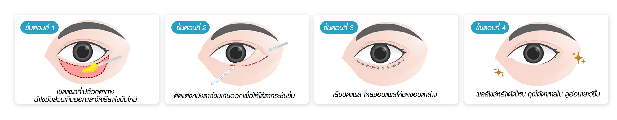 ตัดถุงใต้ตาแผลนอก