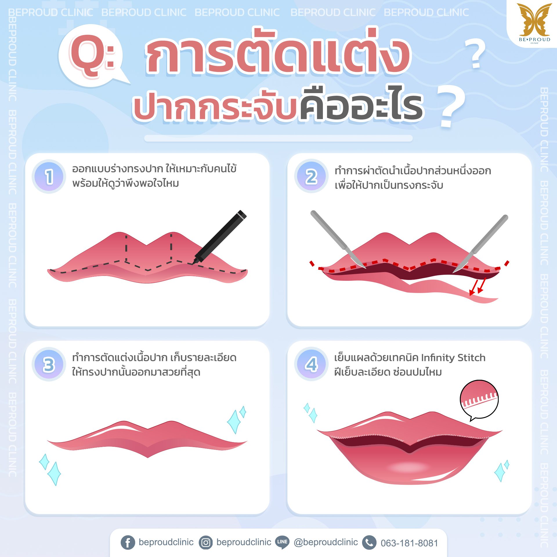 QA-การตัดปากกระจับ คืออะไร ทำปากกระจับ