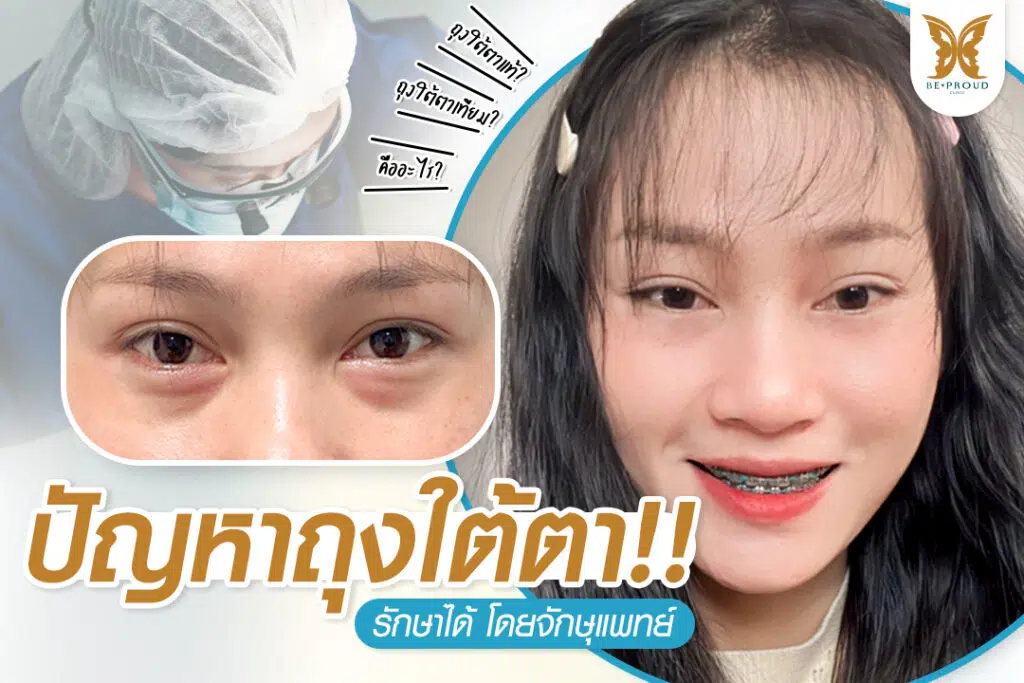 ถุงใต้ตา