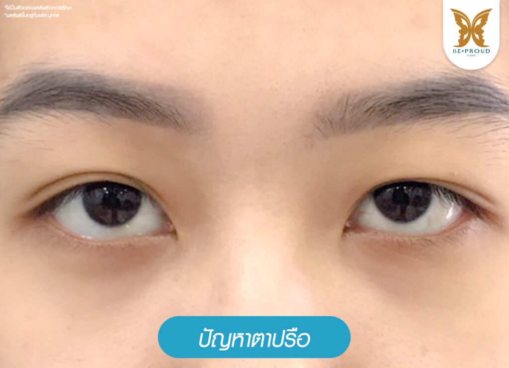 แก้ตาชั้นเดียว