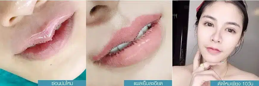 ปากกระจับ ปีกนางฟ้า