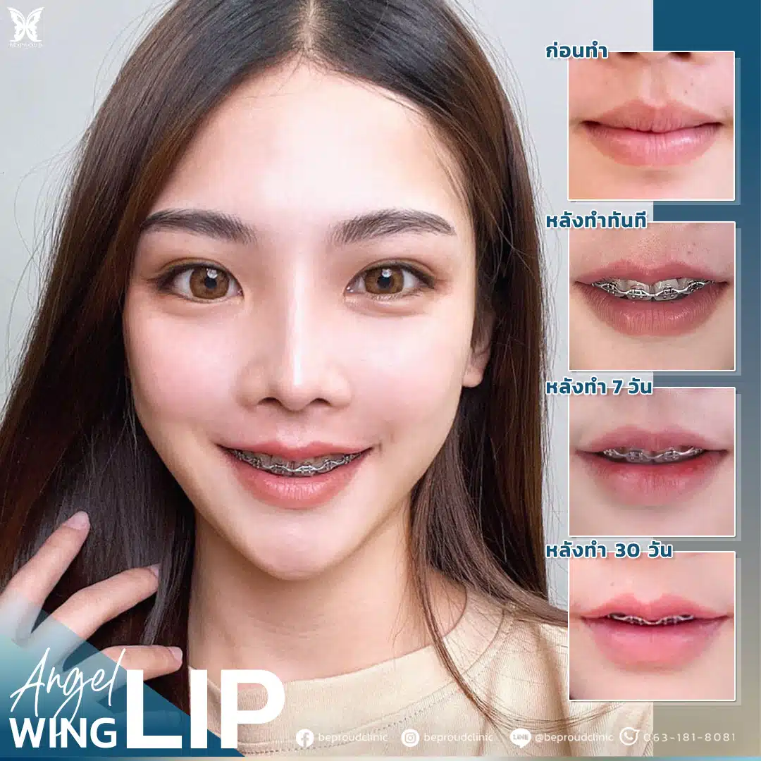 ปากกระจับปีกนางฟ้า บีพราวด์ เทคนิค “infinity stitch”